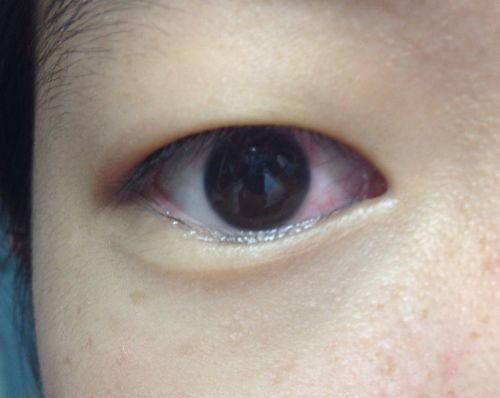 眼睛血丝图片,视觉疲劳的警示信号